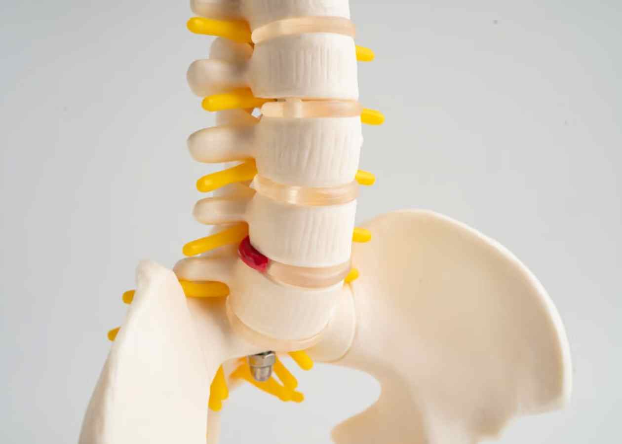 Spinal (Omurilik) Kanal Daralması