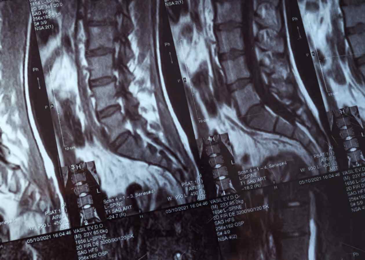 Omurga Kırıkları ve Güncel Tedavi Yaklaşımları