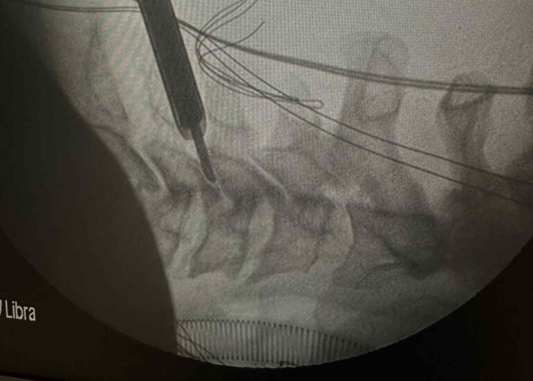 Tam Kapalı (Full Endoskopik) Bel Fıtığı Ameliyatı Nedir? Avantajları Nelerdir?