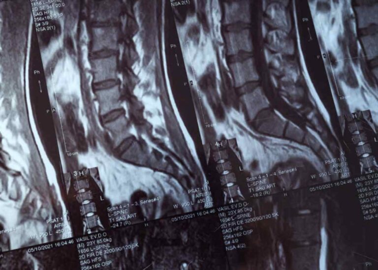 Omurga Kırıkları ve Güncel Tedavi Yaklaşımları