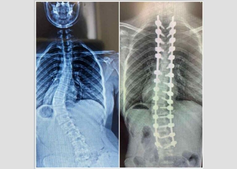 Skolyoz Tedavisi ve İpli Skolyoz Yöntemi