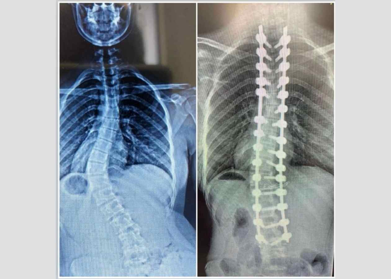 Skolyoz Tedavisi ve İpli Skolyoz Yöntemi